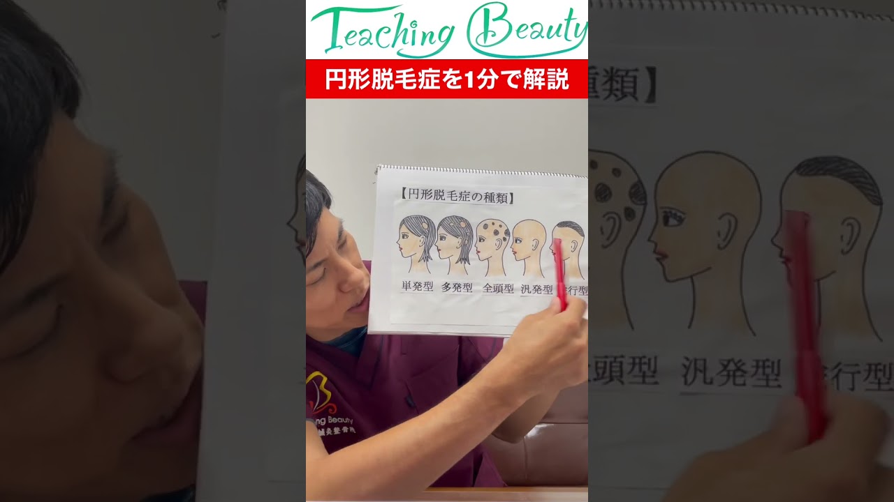 【円形性脱毛症を1分で解説】実は原因はストレスではない！〇〇が本当の原因だ！