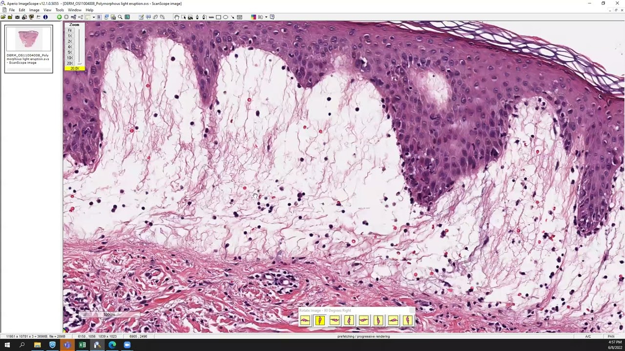 Polymorphous light eruption (PMLE)
