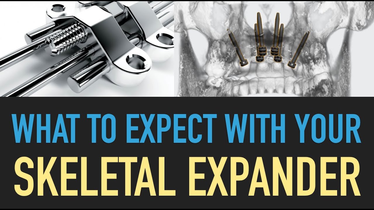 What to expect with your MSE MARPE skeletal expander