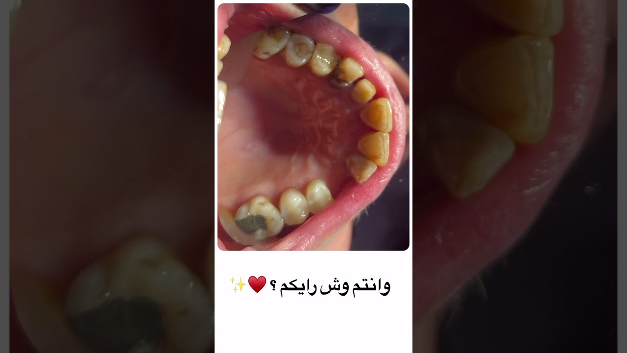 نحاول ان نقدم الافضل لكل المرضى بلا استثناء، فاتقان العمل قيمة كبرى من قيم العيادة &hearts;️✨
