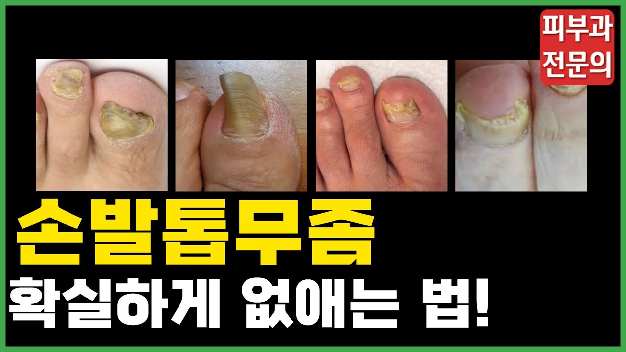 손발톱무좀? 낫고 싶다면 이렇게 하세요! 무좀치료 | 무좀민간요법 | 무좀관리 | 무좀예방