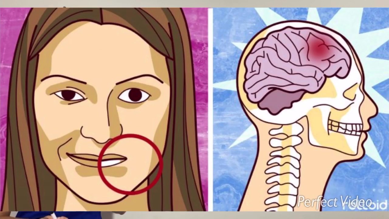 Accidente cerebrovascular 🧠 fisiopatología del ACV isquémico y hemorrágico fácil de aprender! Ictus