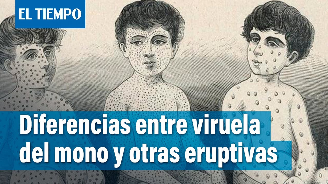 Aprenda a identificar la viruela del mono de otras enfermedades eruptivas | El Tiempo