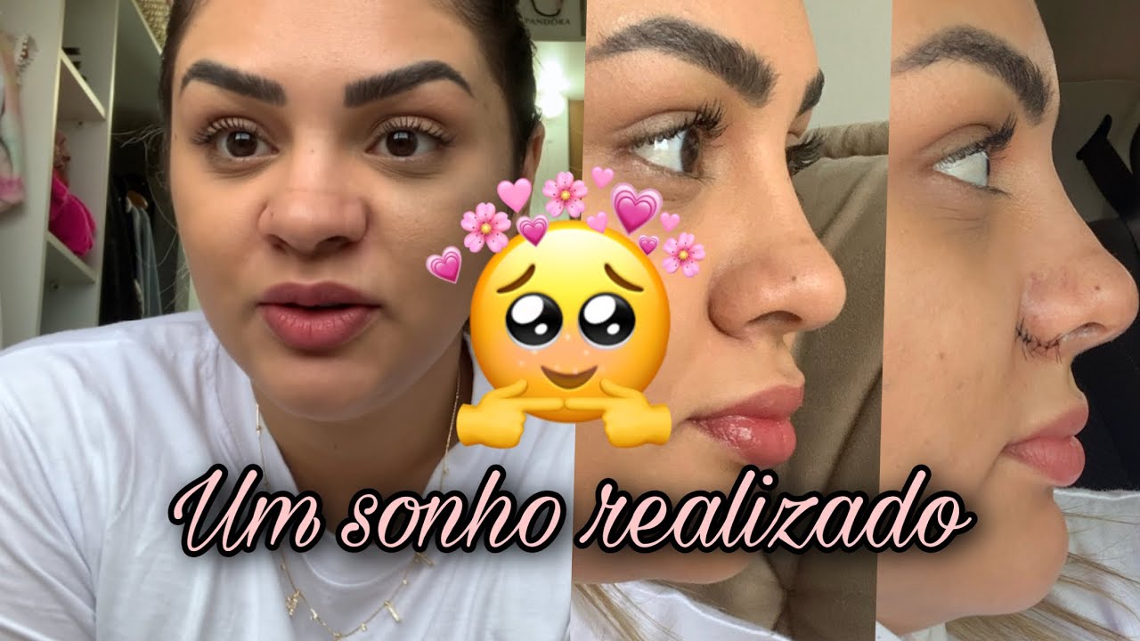 Pós operatório ALECTOMIA +RINOMODELACAO .