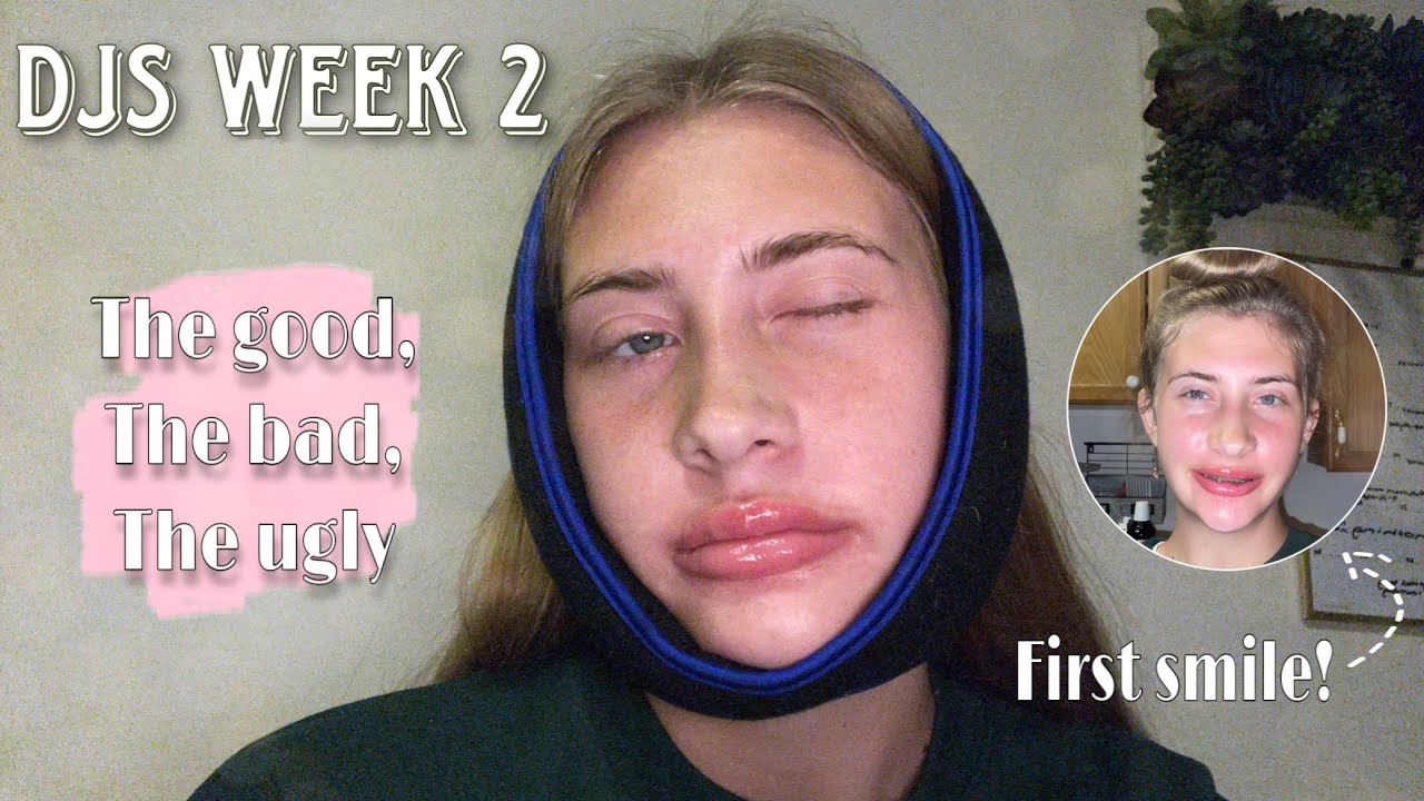 Week 2 Post-Op | DOUBLE JAW SURGERY | pain, movement progression, & staying active
