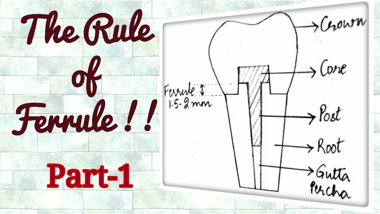 Ferrule Effect- Understanding the Concept!!!