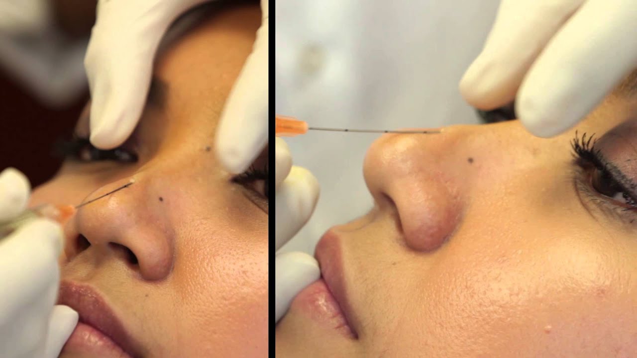 Dr. Kanodia - Nose Filler