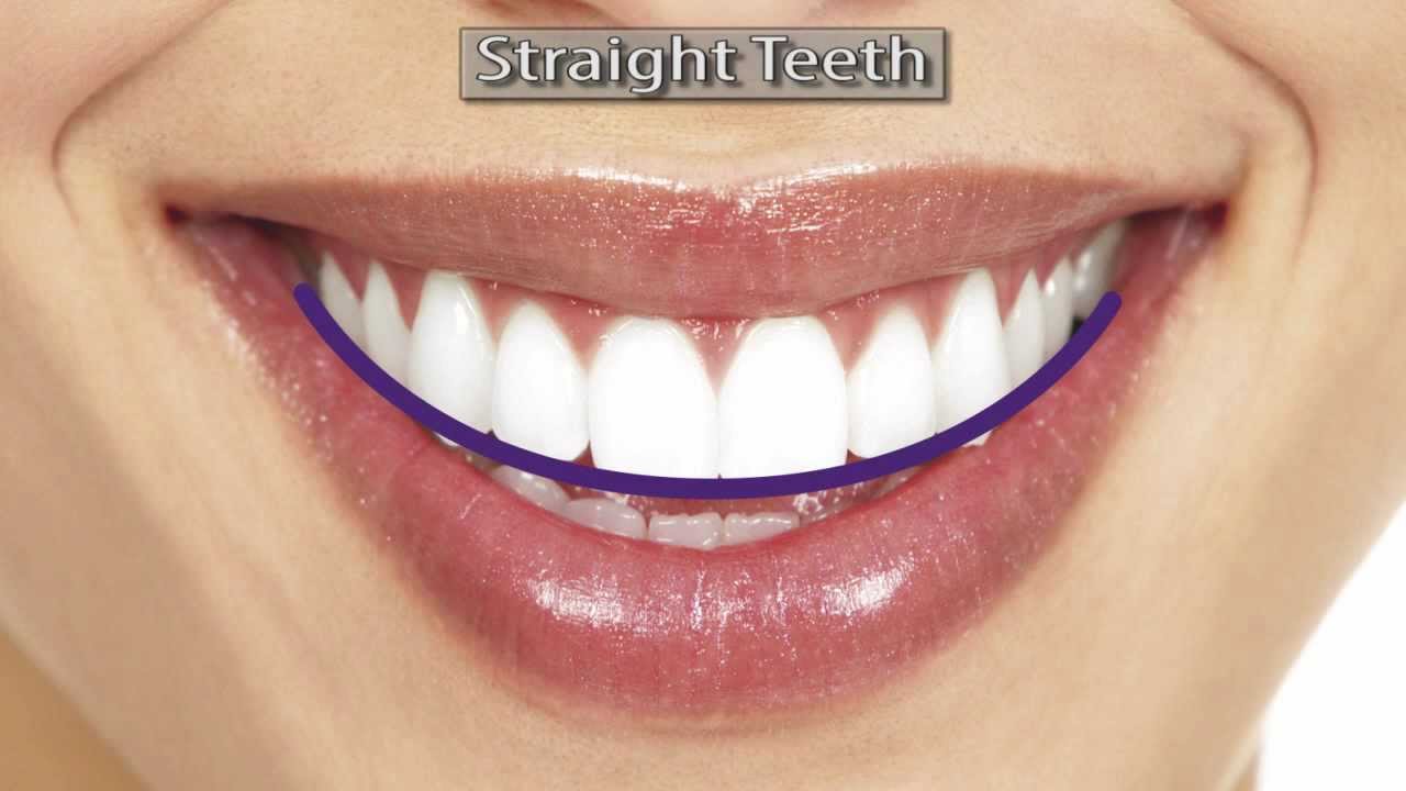 Damon Braces & Clear Damon Braces-- Best Braces to Get and Why?