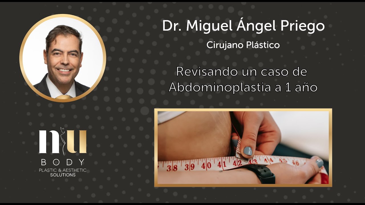 Revisando un caso de #Abdominoplastia a 1 año | Dr. Priego | Nubody | #Cirujanoplásticocertificado