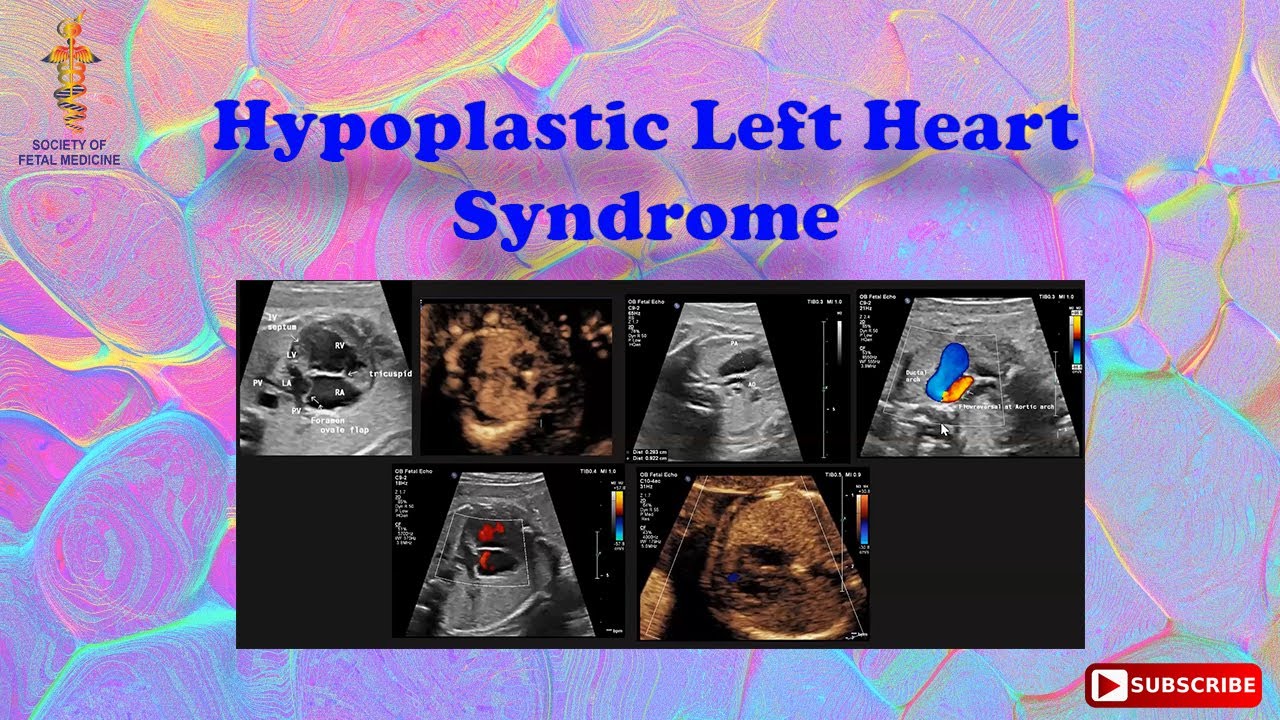 Hypoplastic Left Heart Syndrome