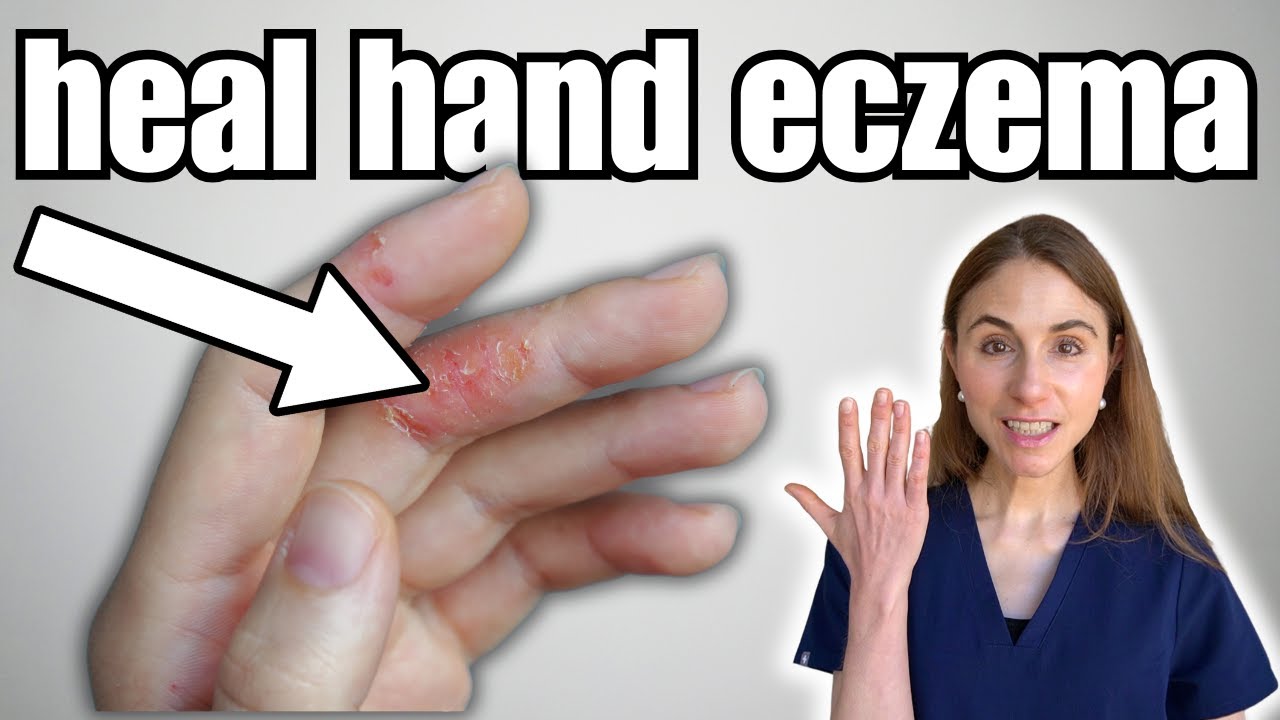 How To Heal Hand Eczema Fast