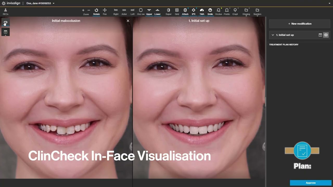 The Align™ Digital Experience | Align Technology Invisalign® | iTero™