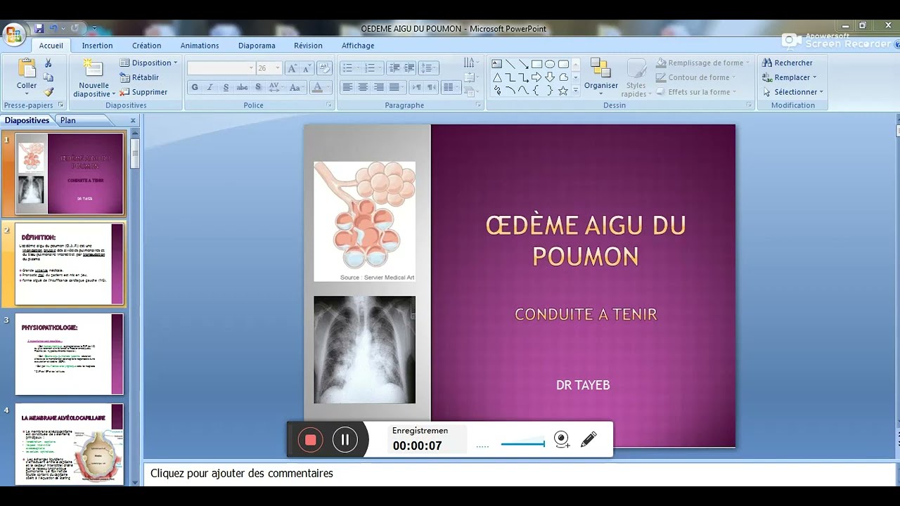 OEDEME AIGU DU POUMON 