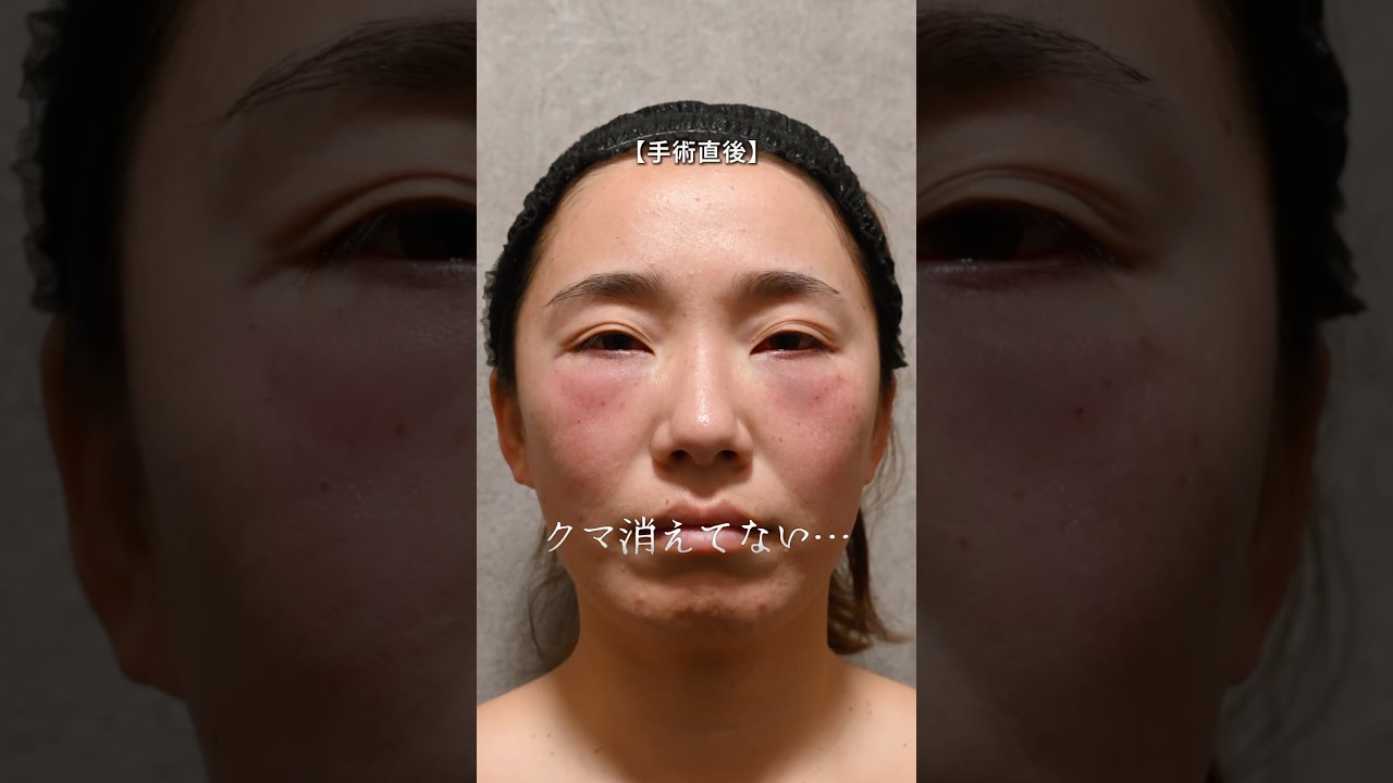 クマ取り失敗...地獄の日々。#クマ取り　#若返り治療 #整形失敗 #クマ治療