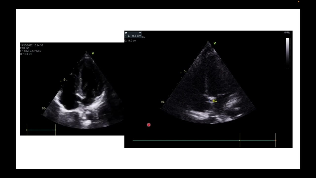 10.2022. Importancia de la evaluacion de las auriculas en POCUS. Dr. Eduardo Alvarado (MEX)