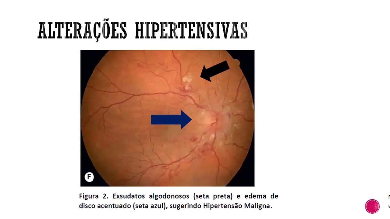 Retinopatia Hipertensiva - Oftalmologia UFC