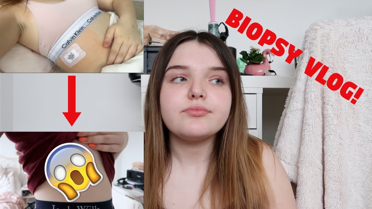 LIVER BIOPSY VLOG!