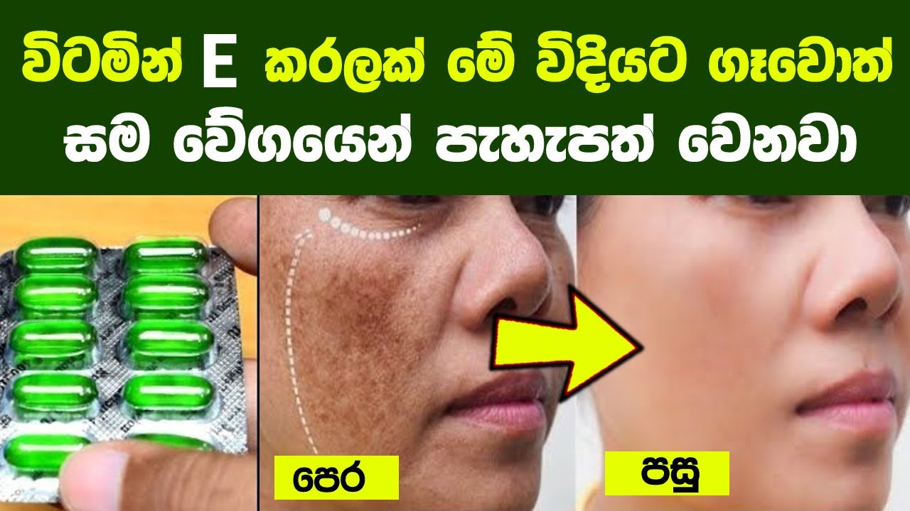 සමේ ඇති අඳුරු ලප කැළැල් ස්ථිරවම ඉවත් කරන ස්වාභාවික ක්‍රම 10ක් | 10 Home Remedies for Pigmentation