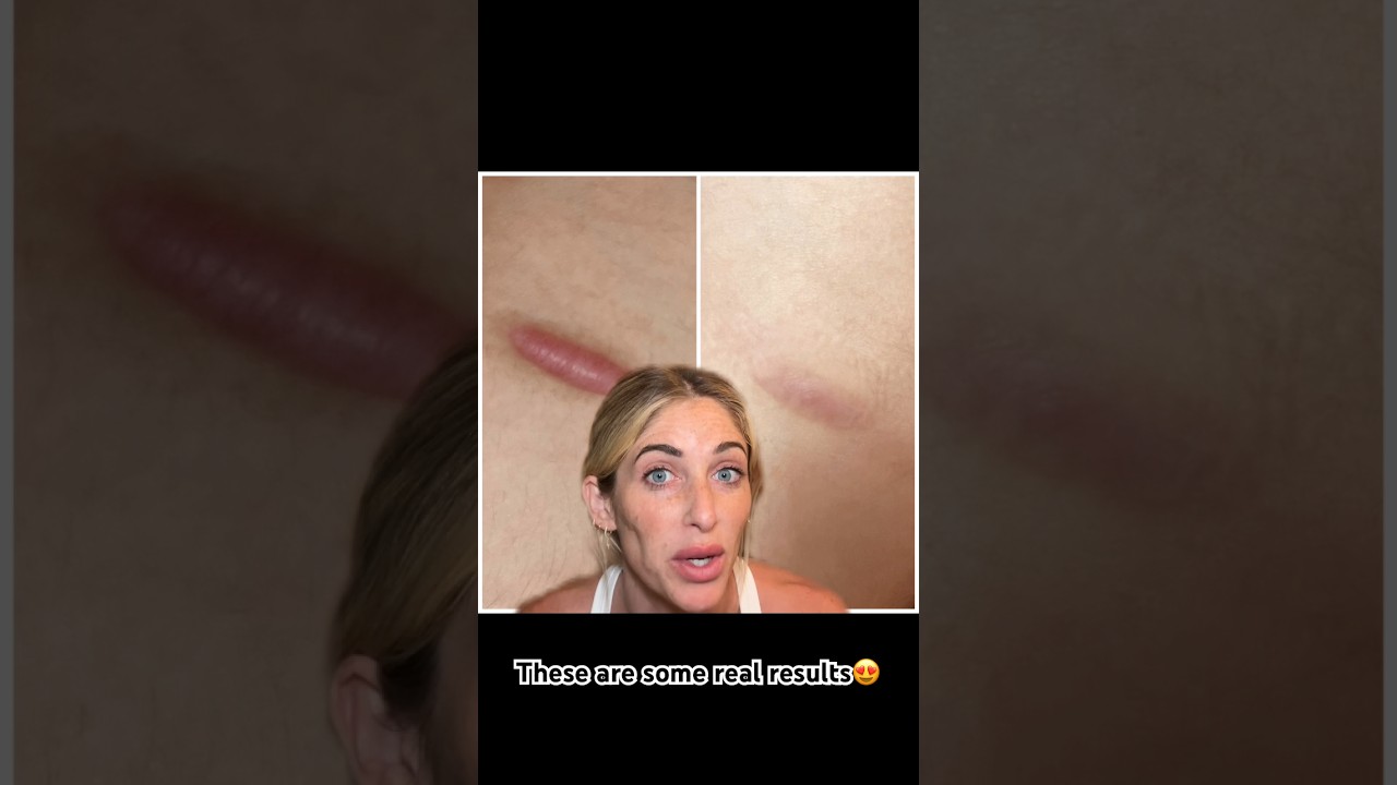 Как избавиться от шрамов | Силиконовые пластыри от шрамов | Как использовать пластыри от шрамов |...