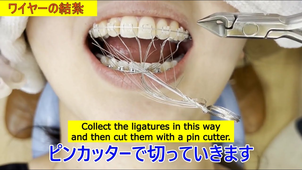 【Orthodontics】Wire replacement procedure in orthodontic treatment |歯列矯正|ワイヤー交換の処置