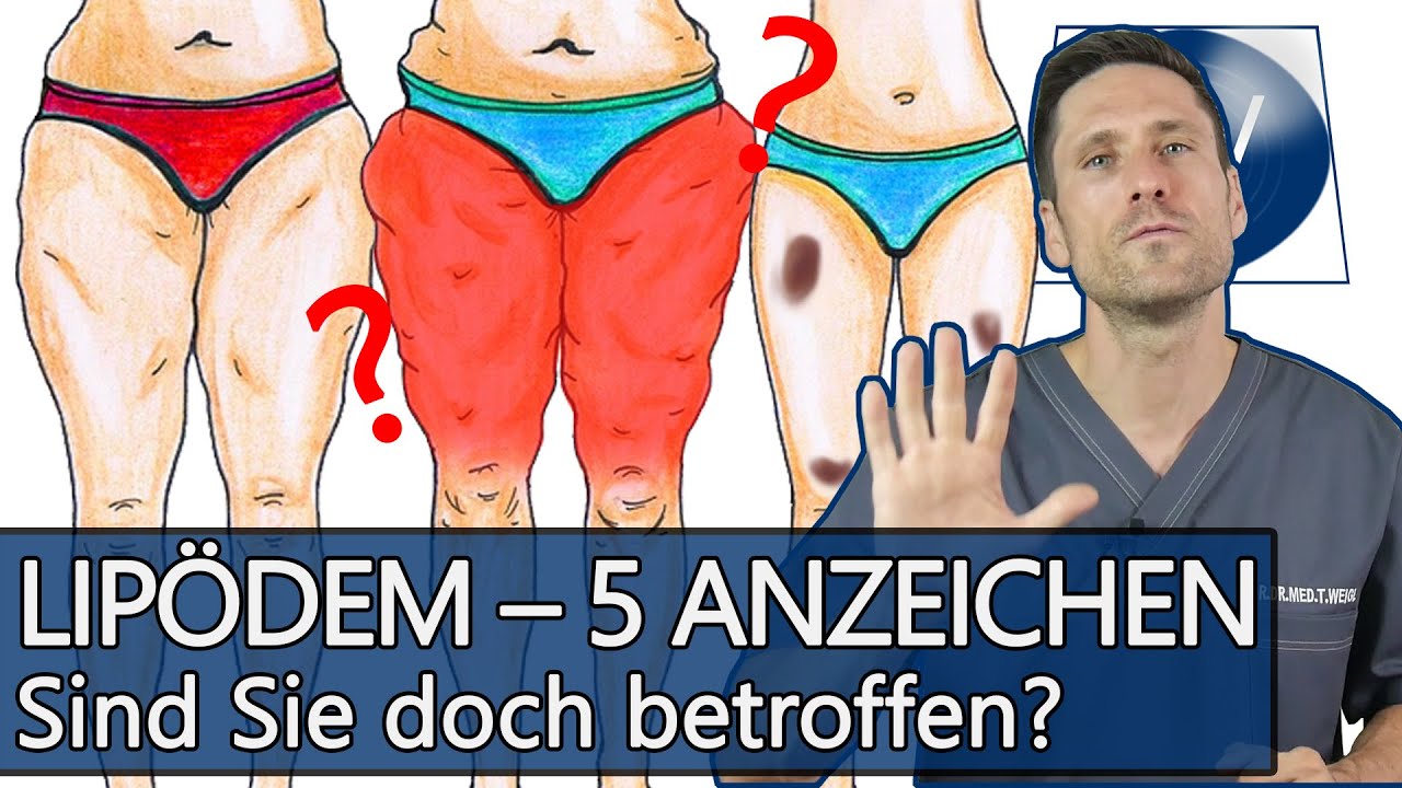 Lip&ouml;dem & dicke Beine: Symptome und erste Anzeichen wenn Beine und Arme sich schrittweise ver&auml;ndern!