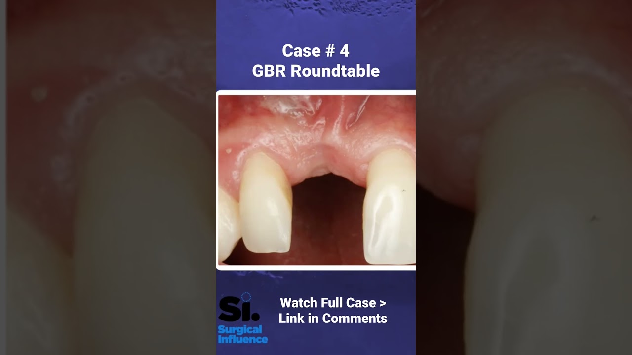 Guided Bone Regeneration | Soft Tissue Case 4 