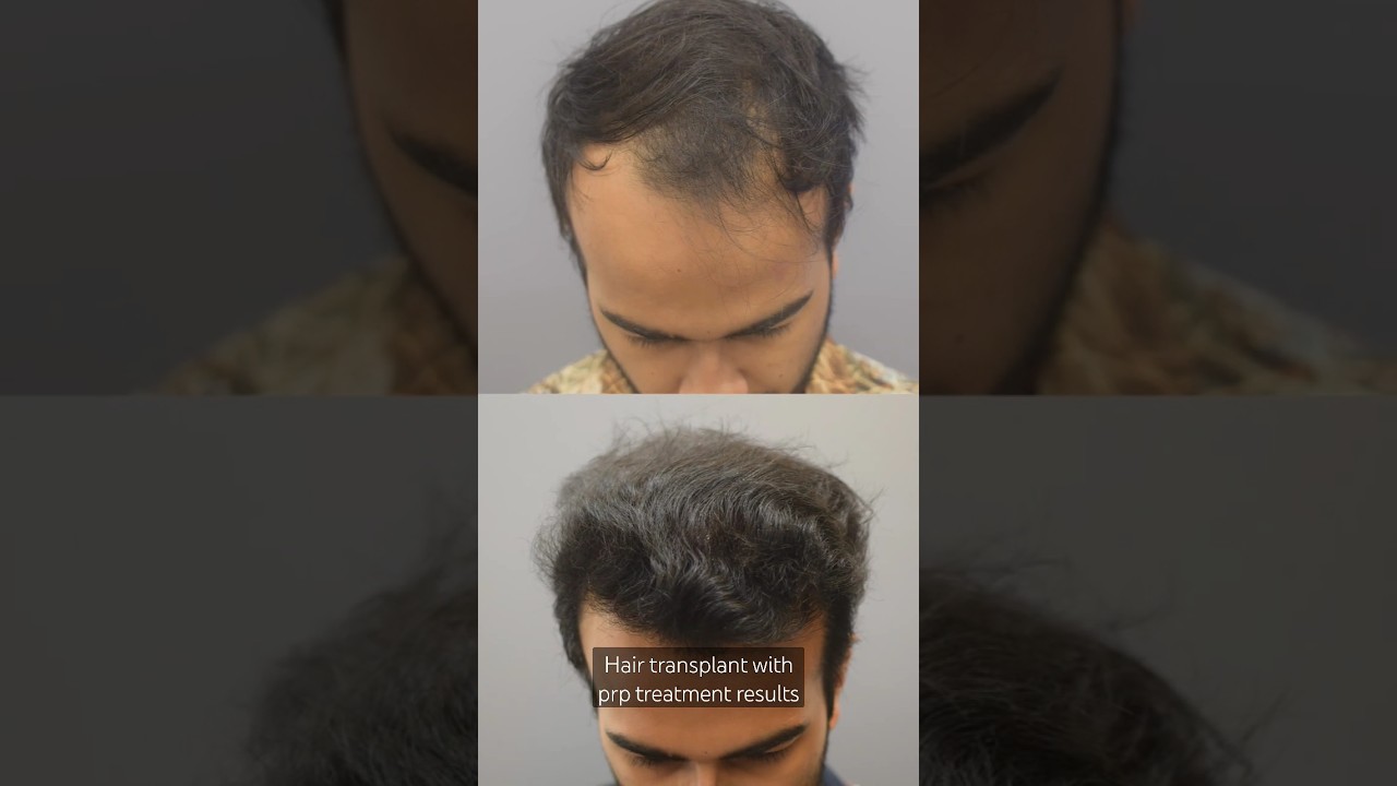 Hair Transplant + PRP for Stunning Results at CARA
