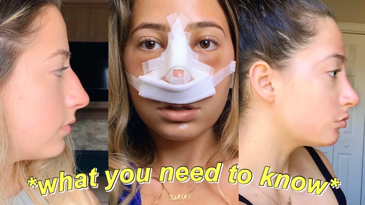 Nose Job Tips *NO ONE* Tells You | 6 MONTH RHINOPLASTY UPDATE