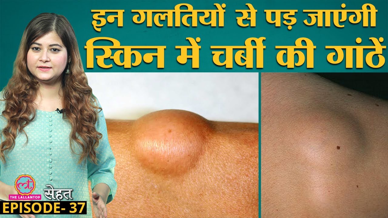 क्या होता है Lipoma जिसमें skin के अंदर चर्बी की गांठ बन जाती है? जाने इलाज के तरीके | Sehat Ep 37
