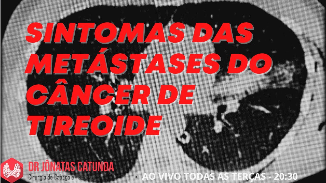 Sintomas das metástases do câncer de tireoide - Vídeo ao vivo respondendo dúvidas