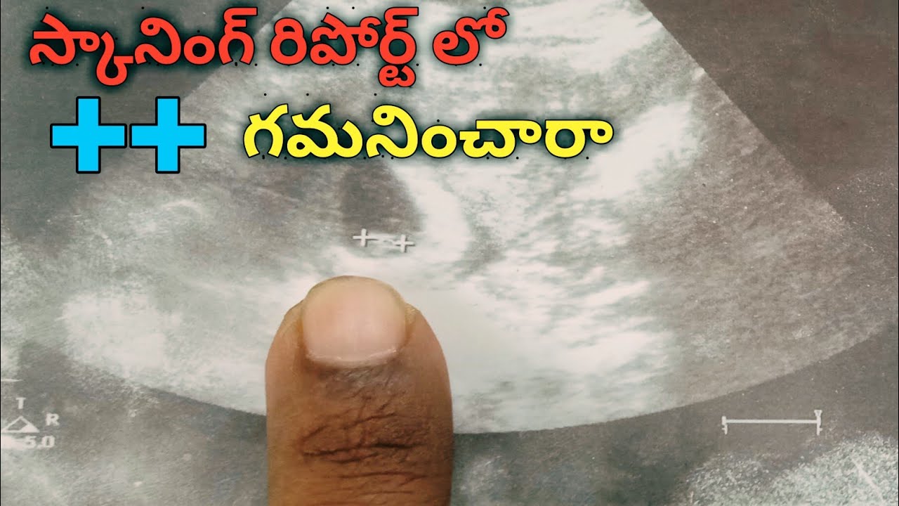 scan report lo ++ | scan reports lo ++ or xy | స్కానింగ్ రిపోర్ట్ లో ++ ని గమనించారా