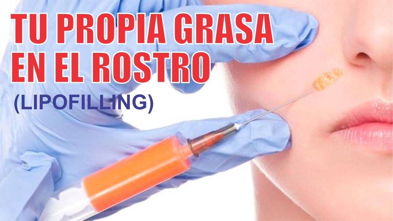 LIPOFILLING o LIPOTRANSFERENCIA al ROSTRO 👸🏻 Tu propia GRASA en el rostro ❤️ Dra. LIZBETH ZU&Ntilde;IGA