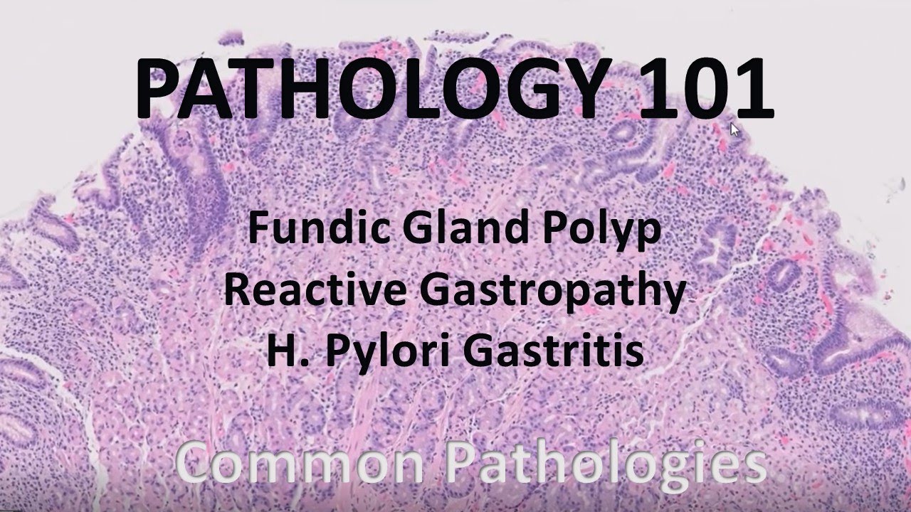 Fundic Gland Polyp, Reactive Gastropathy, and H. Pylori gastritis | Pathology 101| GI Pathology