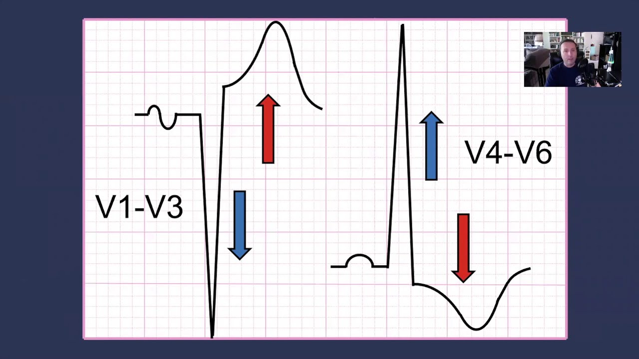 Left Ventricular Hypertrophy