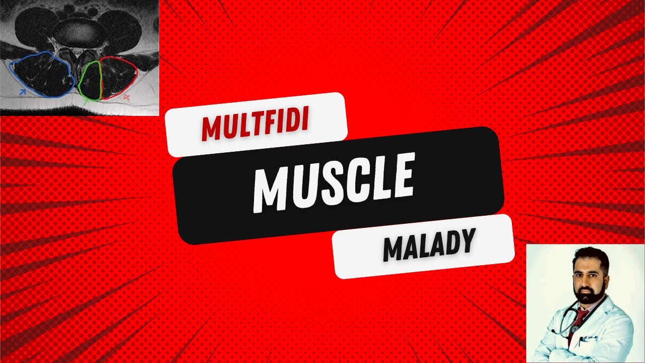 Multifidus Muscle Malady: A Cause of Chronic Low Back Pain