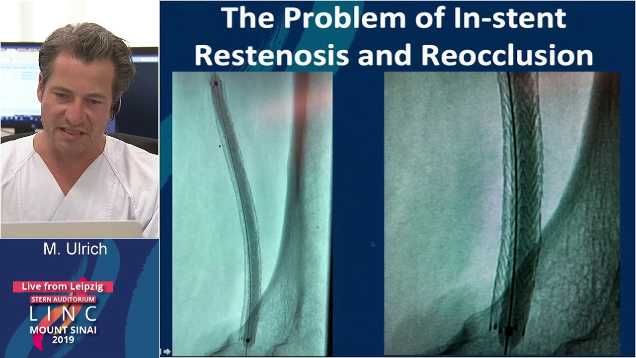 Stern D1 - Rotarex Atherectomy: Vessel Prep for DCB and Evolving Indications - Dr. Ulrich
