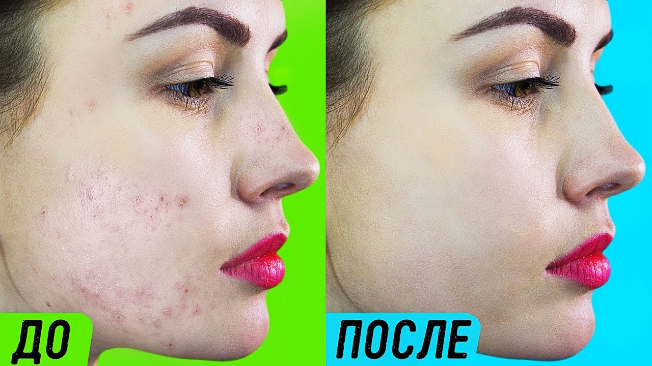 КАК ИЗБАВИТЬСЯ ОТ ПРЫЩЕЙ ЗА ОДНУ НОЧЬ