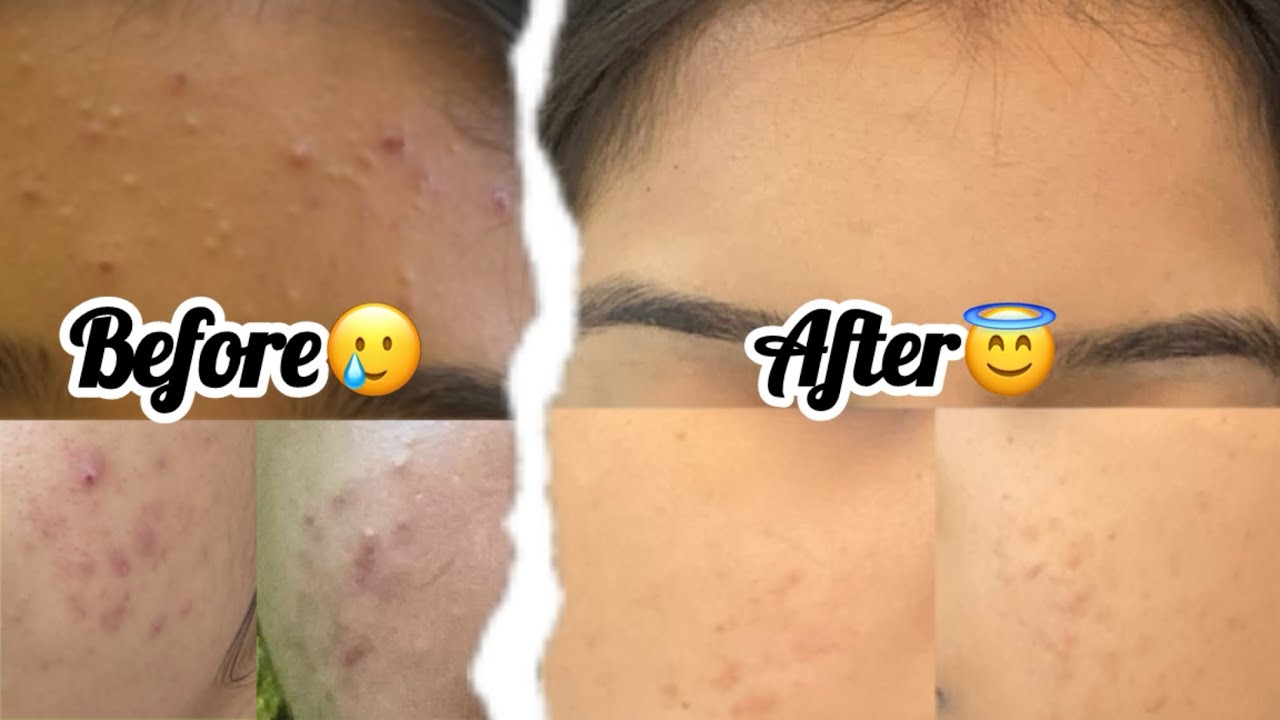 How i cleared my acne🥲|My Skin journey