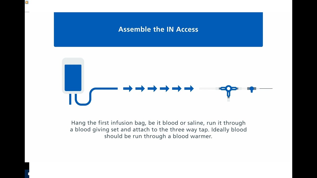 Setting up and Performing a Manual Exchange Red Cell Exchange in Sickle Cell Disease (Over 40kg)
