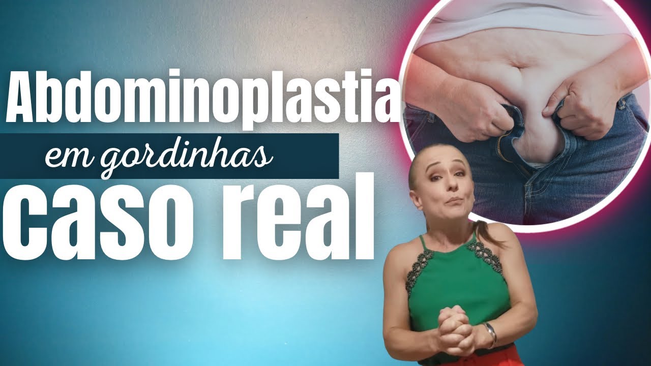 Abdominoplastia em gordinhas (caso real)