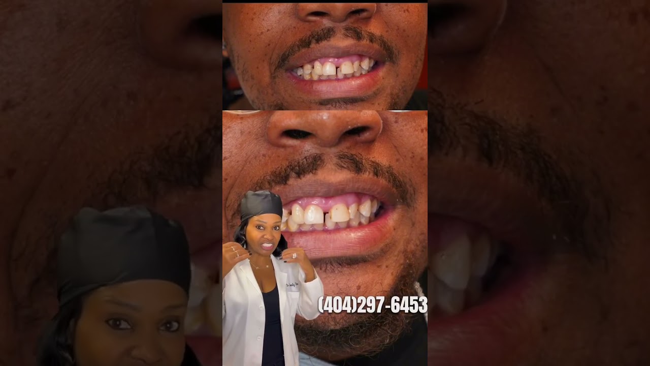 Give your #smile the Heavenly touch! Call 404-297-6453 #implants #veneers #dentist #transformation