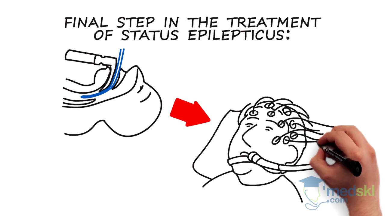Neurology – Status Epilepticus: By George Porfiris M.D.