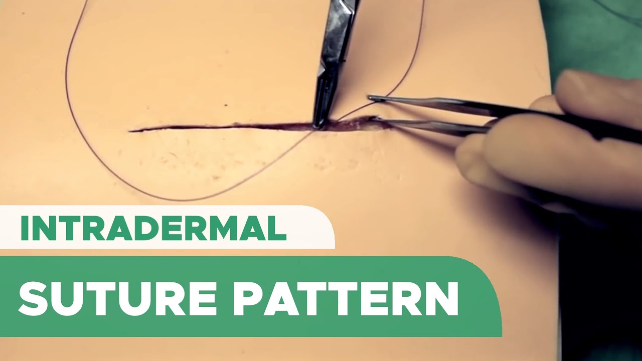 Intradermal Suture Pattern (Subcuticular Suture  &ndash; Intracutaneous Suture)