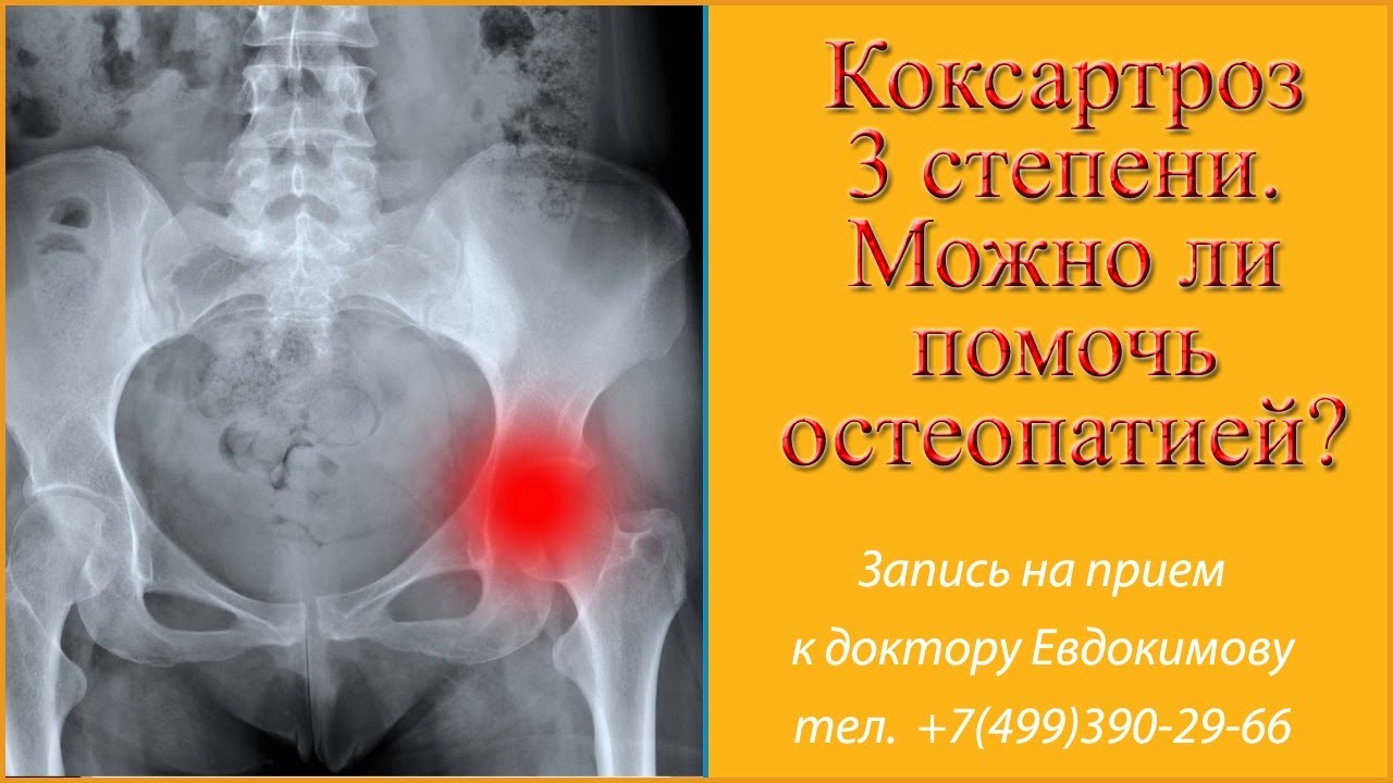 У меня коксартроз 3 степени. Поможет ли остеопатия при артрозе