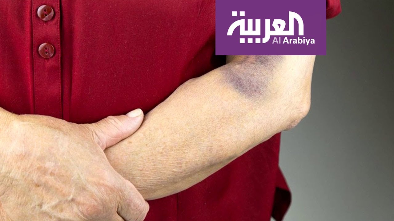 صباح العربية | ما سبب ظهور البقع الزرقاء تحت الجلد؟