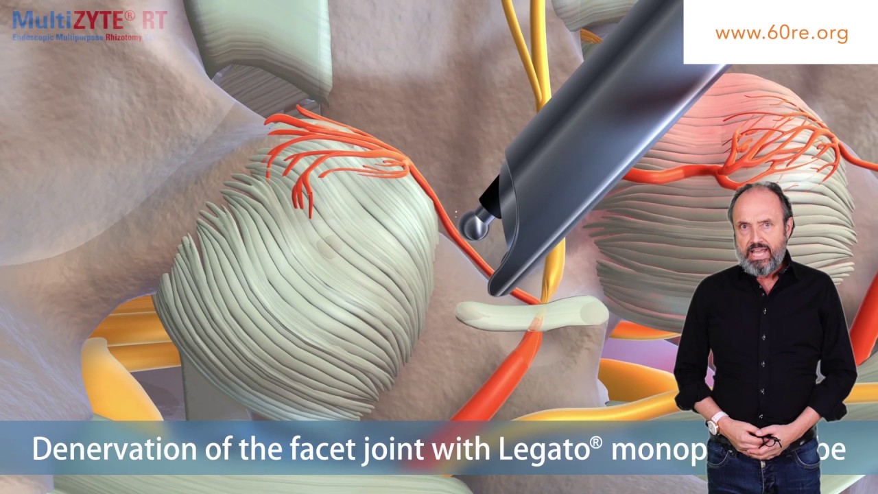 Facettensyndrom gezielt behandeln – aber wie? - Peter Sigg