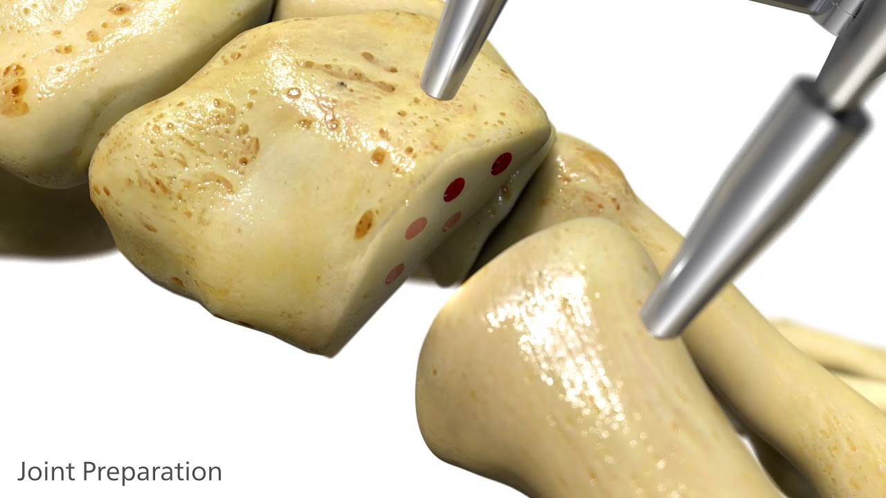 ORTHOLOC™ 2 LapiFuse™ Triplanar Bunion Correction Animation