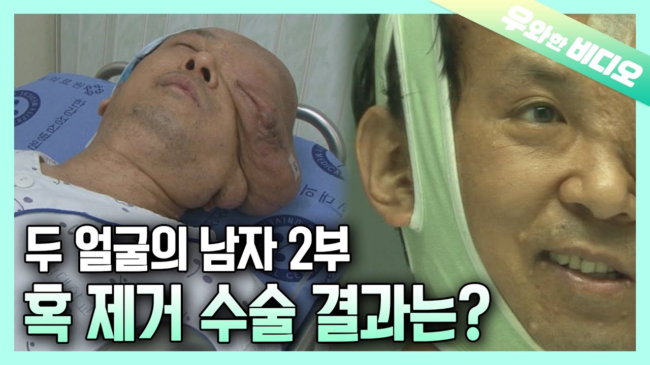 (2부) 얼굴의 반쪽을 뒤덮은 혹, 제거 수술 그 결과는&hellip;?┃(Ep.2) Removing the Lump That Covers Half of His Face...
