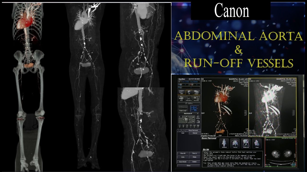 CT LOWER LIMB ANGIOGRAM || CT Scan of Abdominal Aorta Including Run-off Vessels. #basicradiology