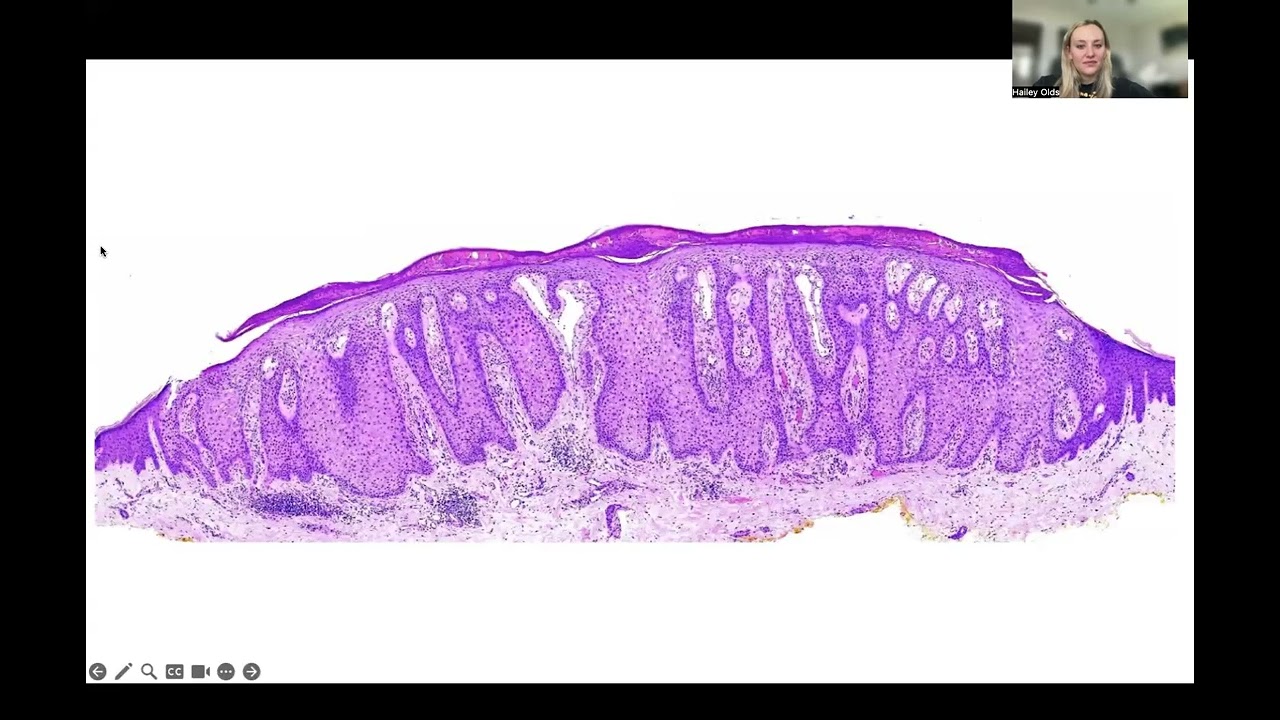 Benign Tumors and Cysts of the Epidermis (Dermpath)
